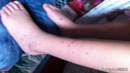 春天孩子皮肤过敏怎么办,儿童春天过敏身上起红疙瘩