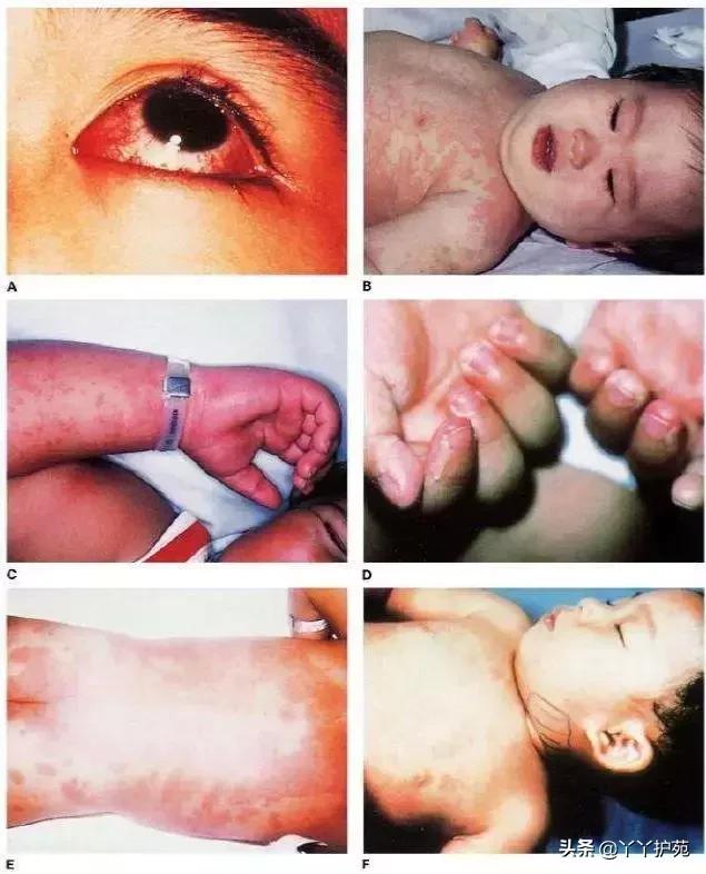 儿科常见出疹性疾病,儿科常见出疹性疾病有哪些