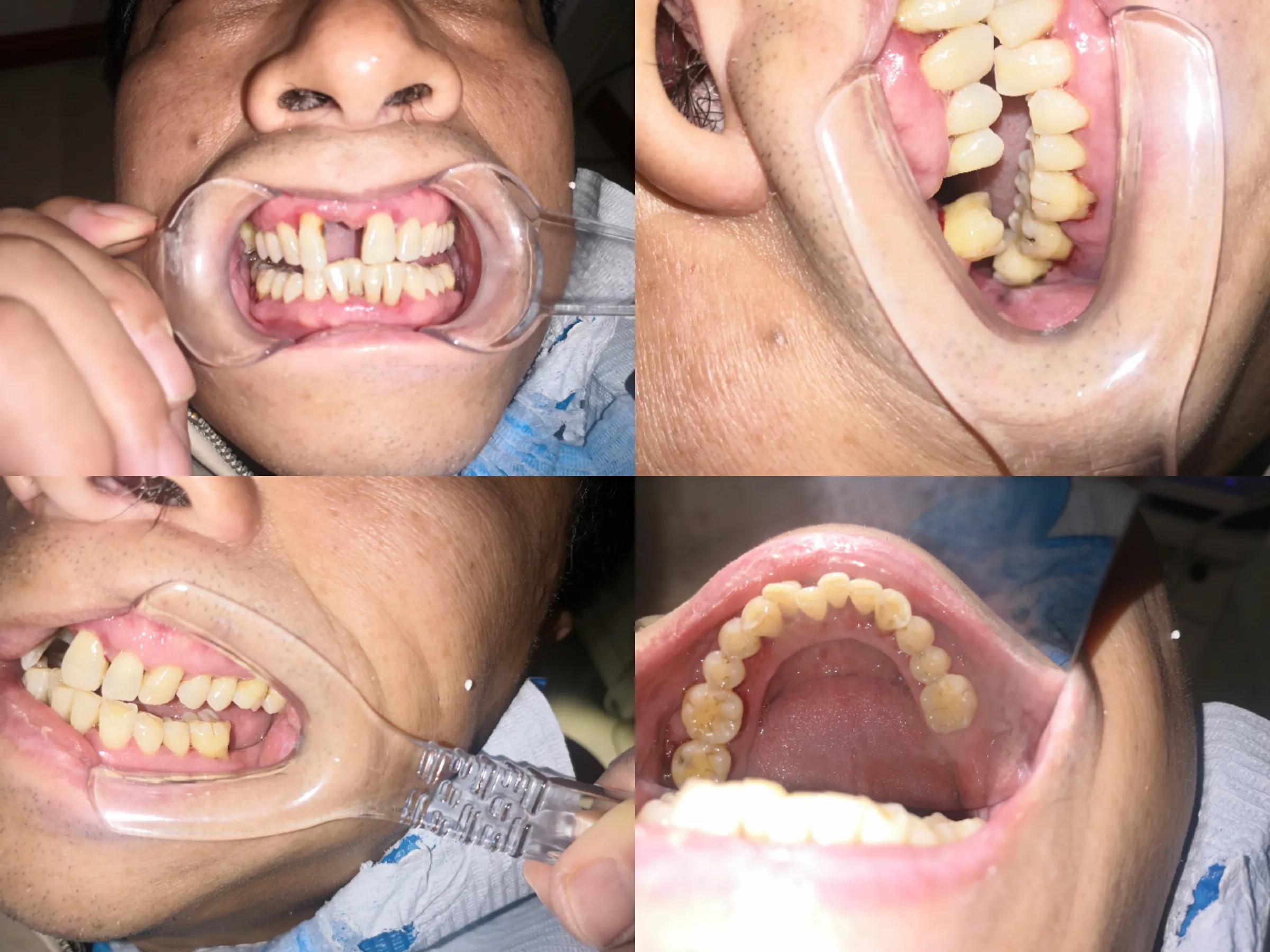 口腔卫生保健讲座第三讲牙菌斑及牙结石