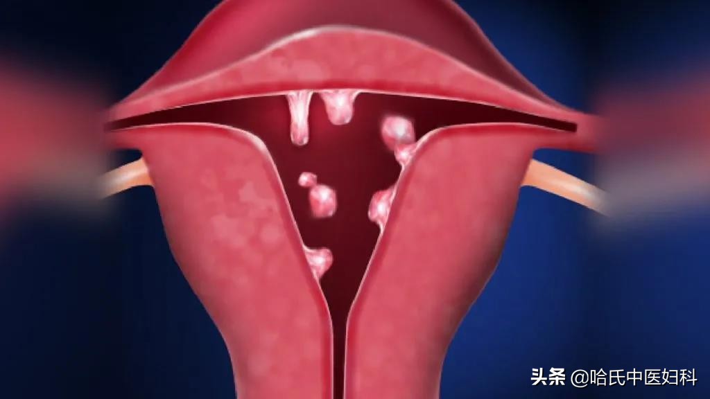 子宫息肉一年复发三次,子宫内膜息肉半年复发一次怎么办