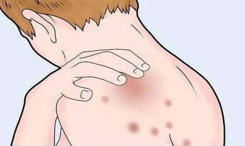 宝宝湿疹怎么办才好得快,宝宝得了湿疹怎么处理好得快