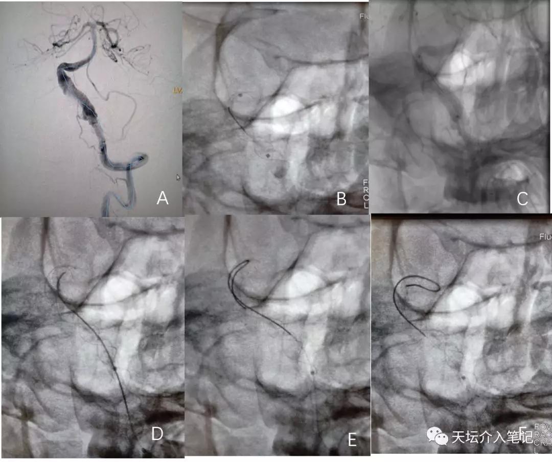 密网支架治疗脑动脉瘤术后效果图,密网支架治疗基底动脉假性动脉瘤