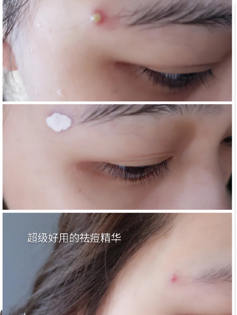 雅漾祛痘精华祛痘效果怎么样,护肤品推荐祛痘控油