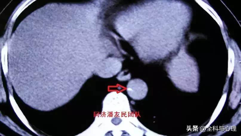 诊断主动脉夹层，千万别犯这种错误！