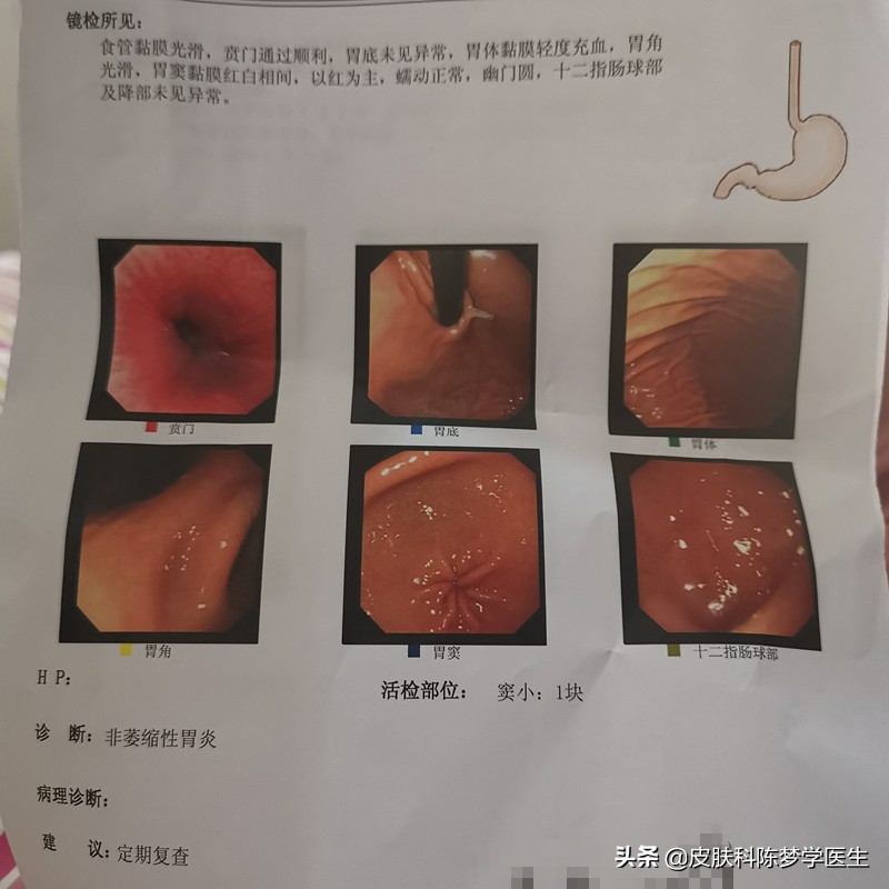 做无痛胃肠镜的真实感受,无痛胃肠镜经历