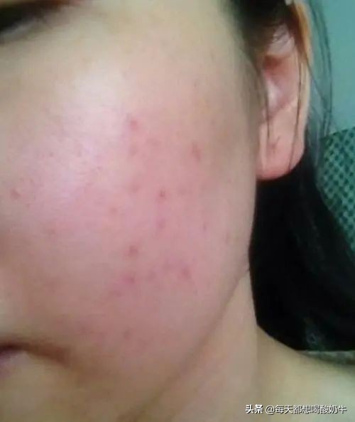 如何改善脸上皮肤特别薄，一直泛红，毛孔粗大，*血丝红**明显？