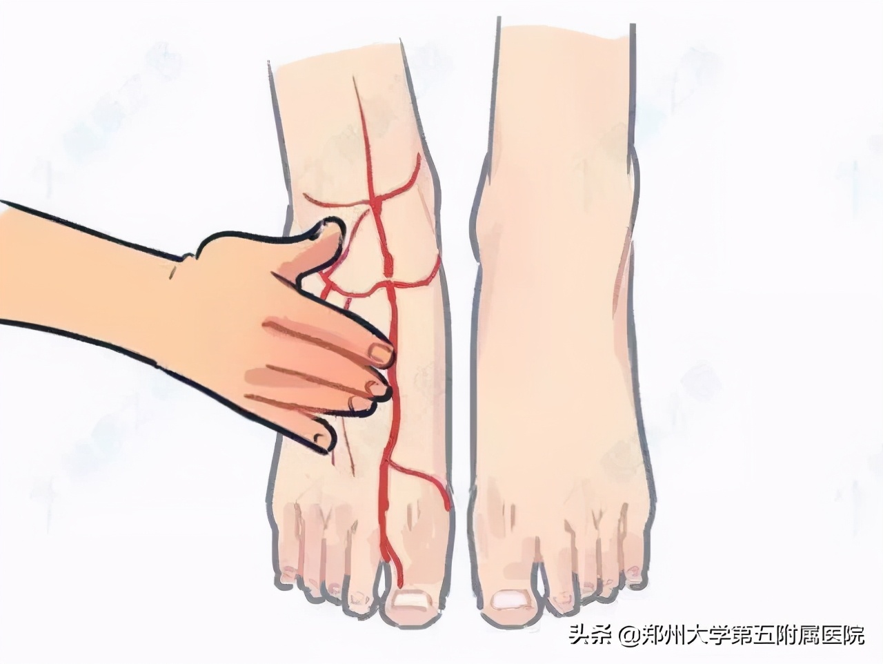 腿上放支架的风险和副作用,腿上放了钢板拿出来有后遗症吗