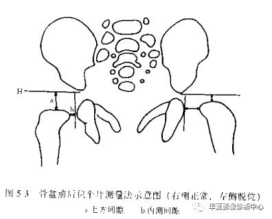 先天性髋关节脱位饮食,先天性髋关节脱位属不属于残疾人