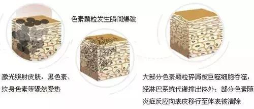 激光祛斑后的护理怎么做,皮秒激光祛斑术后护理