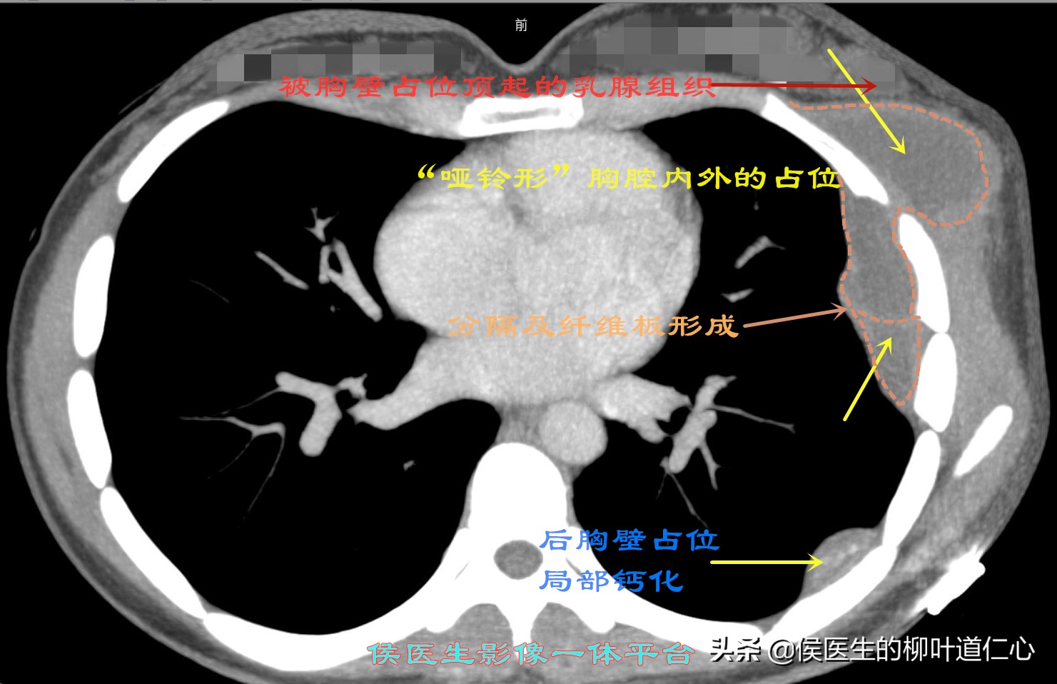 结核杆菌会引起肺结节吗,肺结节诊断为肺结核