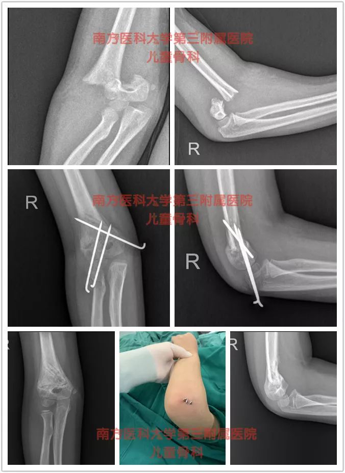 胳膊骨折三个月腿又骨折,孩子胳膊骨折好后还容易骨折么