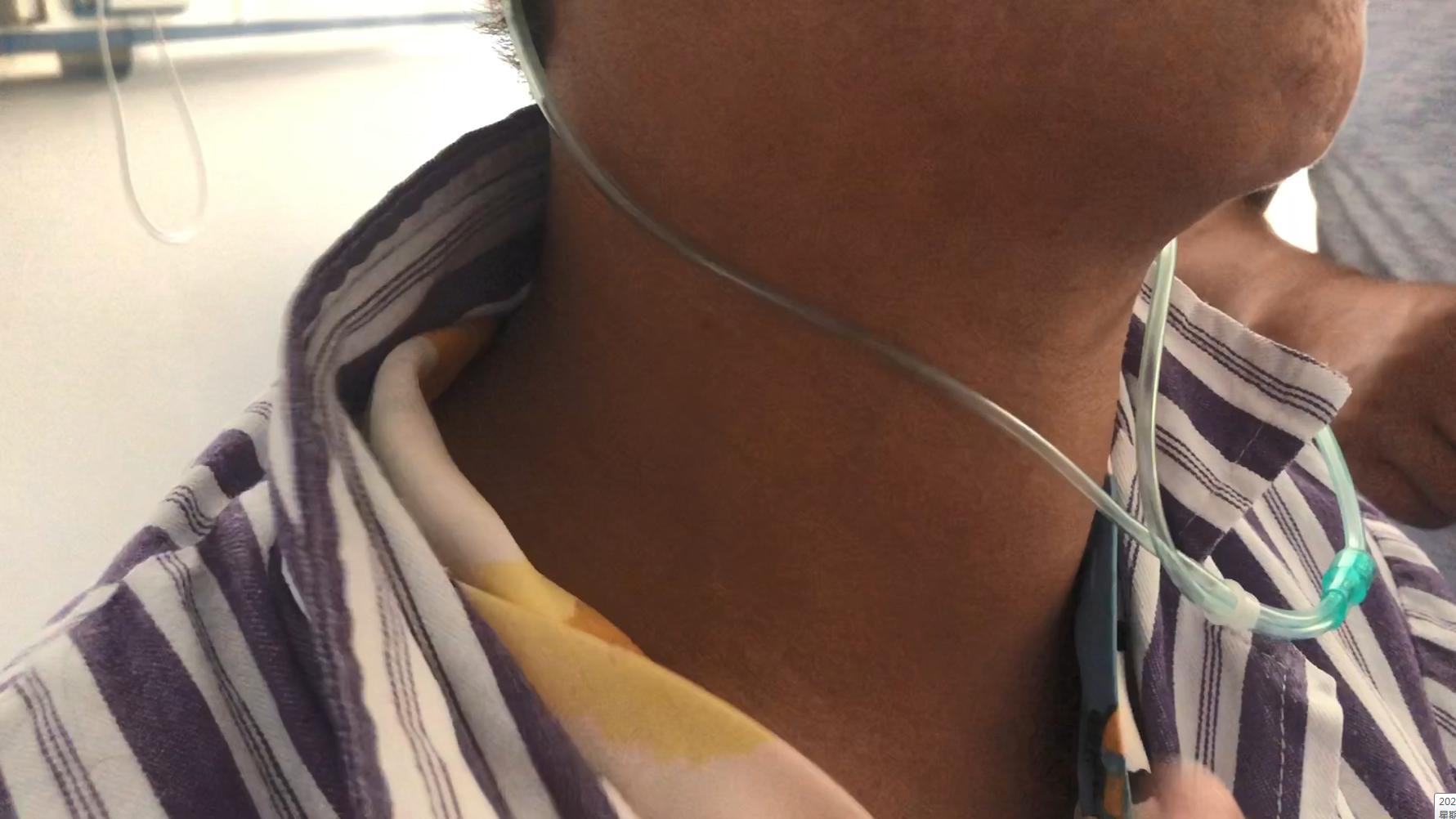 甲亢致人死亡,甲亢实际案例