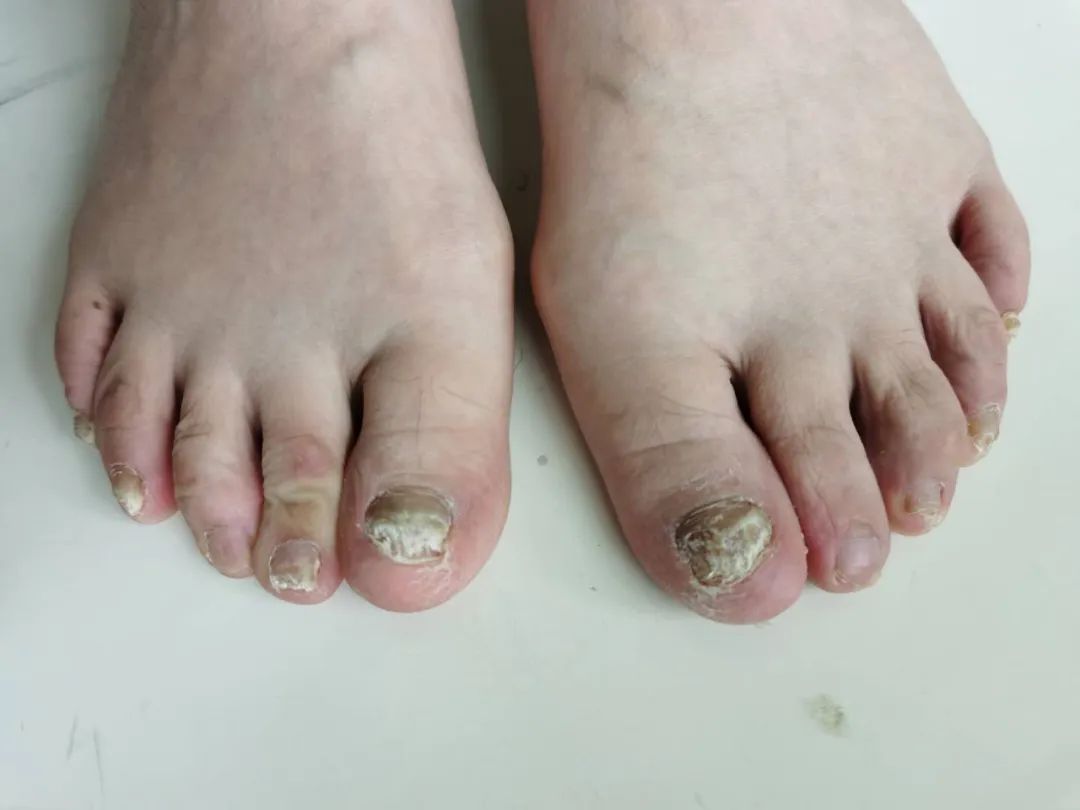 及时治疗脚气,是对家人最好的负责