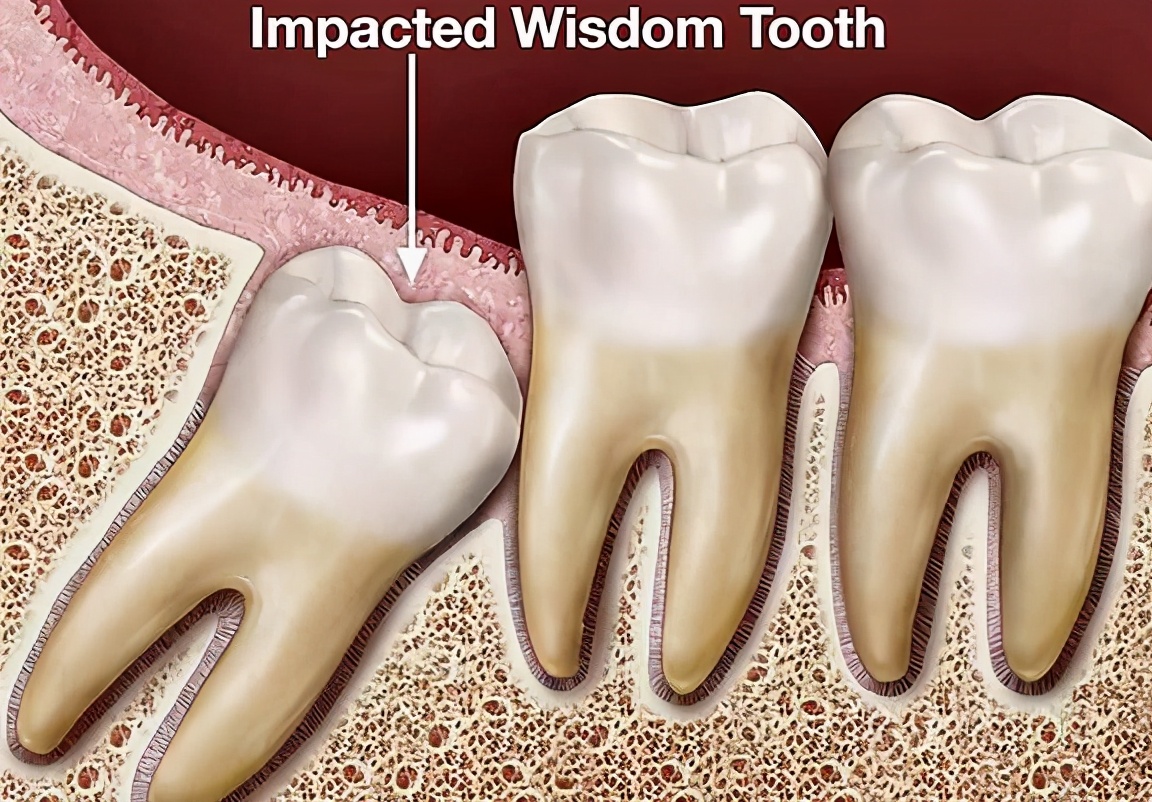 出现智齿会有什么状况,横着长的智齿在肉里没症状要拔吗