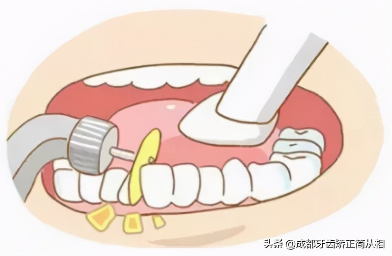 儿童牙齿拥挤矫正,牙齿拥挤矫正过程