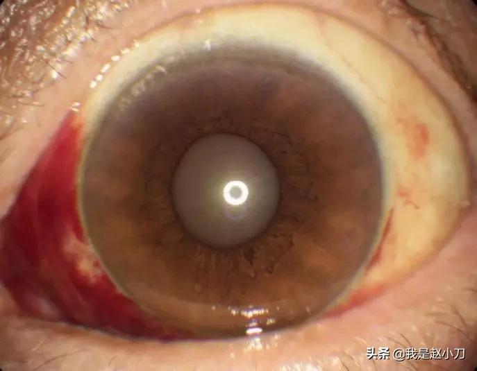 肺炎能通过眼睛传播吗?家里能用紫外灯消毒吗?