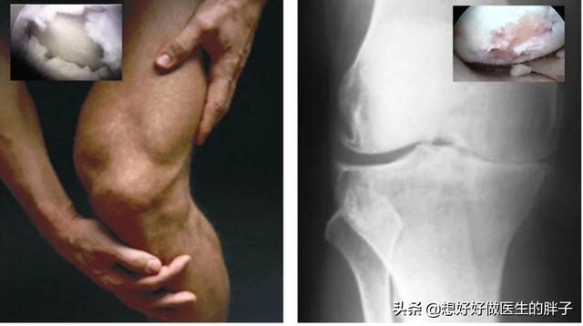 膝关节骨刺正确治疗方法,膝关节骨刺怎么缓解症状