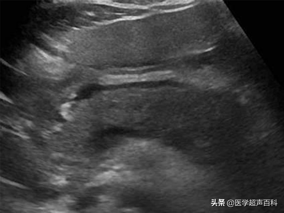 消化系统急性胰腺炎病人的护理,急性胰腺炎胃肠功能恢复的标志