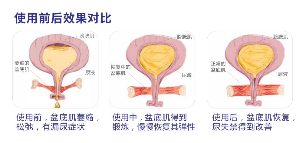 盆底肌电评估及生物反馈报告,生物刺激反馈治疗盆底肌修复