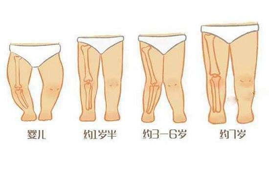 儿童膝内翻去哪里治疗,膝内翻如何矫正儿童