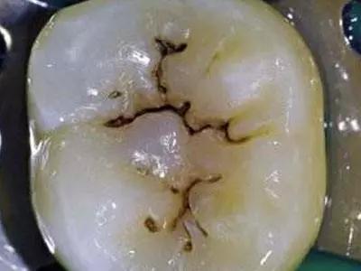 刷牙把牙齿根刷有条缝怎么办,横向刷牙把牙齿快刷断了怎么补救