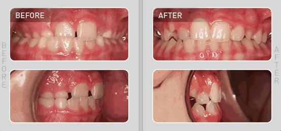 mrc矫正器小孩子晚上不愿意咬,mrc儿童牙齿矫正