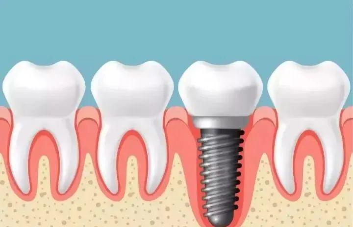 为什么都建议种植牙,种植是目前最好的缺失牙修复方式