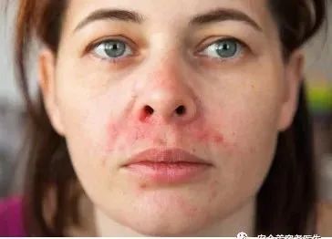 面部反复起红斑红疹是什么炎症,脸部痒没有皮疹是什么原因