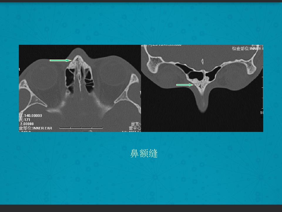 鼻骨骨折复位全过程,诊断证明鼻骨骨折问号是什么意思