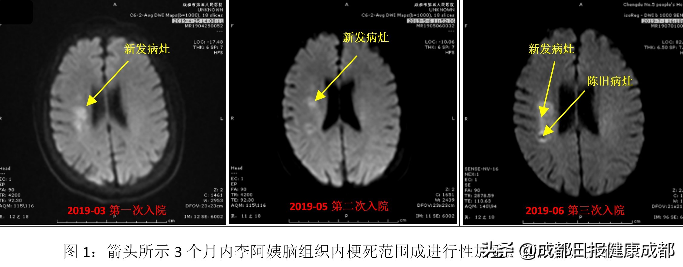 如何控制脑血管中风,脑血管堵了三根做搭桥还是支架