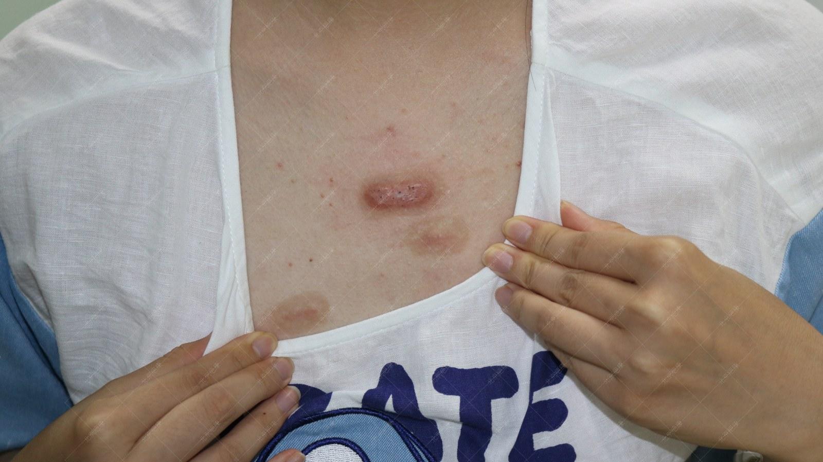 北京疤康怎么治疗疤痕,疤康医院治疗疤痕增生如何