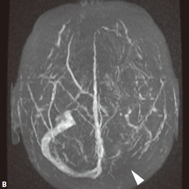 颅内血管轻度狭窄诊断标准,颅内血管先天变异影像