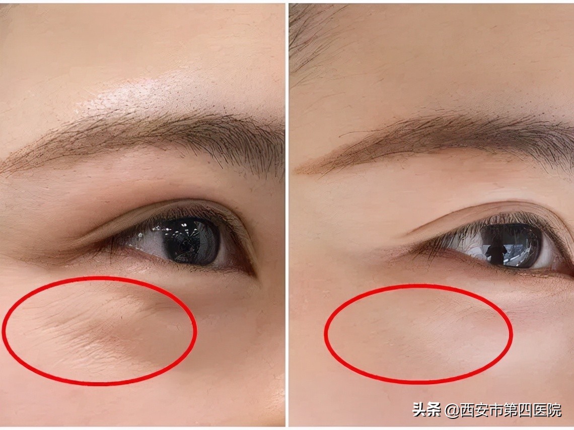 #安心变美课堂##我的安心变美推荐#了解它的真面目，注射去鱼尾纹！