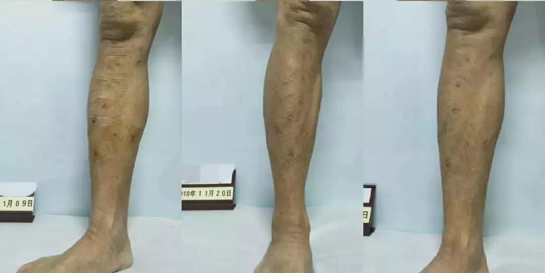 青岛第八人民医院义诊,山东青岛市立医院治疗静脉曲张