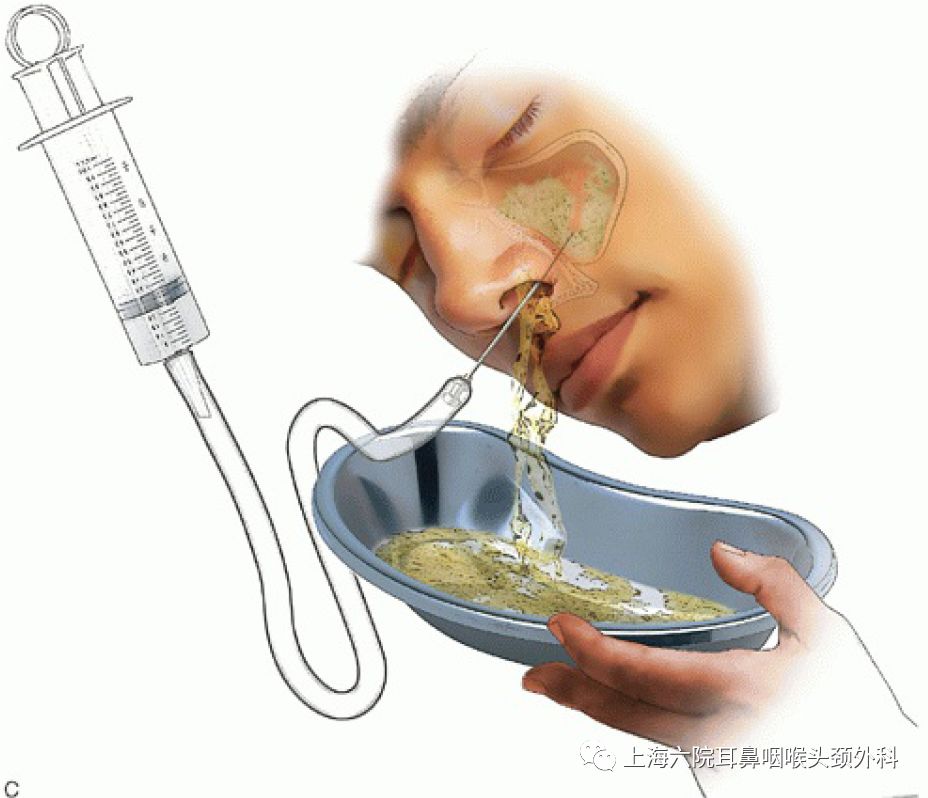 上颌窦炎穿刺手术全过程,上颌窦炎一般小门诊能治疗吗