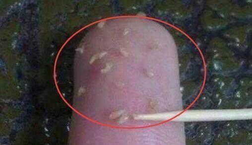 如何彻底消灭在痘痘里的螨虫,痘痘里面有米粒怎么全部去除