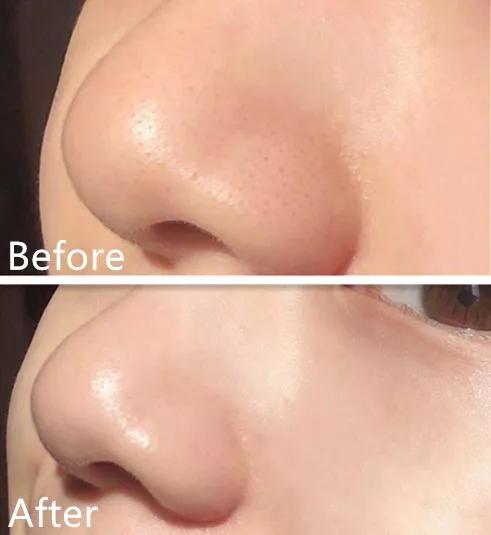 有黑头和没黑头有什么区别,没有长过黑头却长黑头怎么办