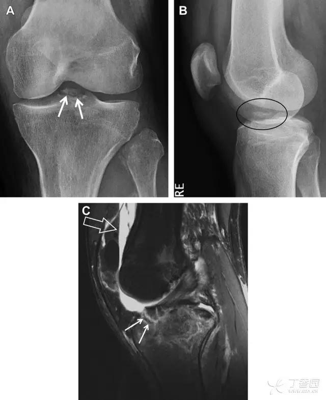 值夜班急救措施,放射科容易漏诊的骨折