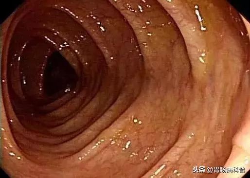 我做普通肠镜的经历及感受,年轻人做普通肠镜可以忍受吗