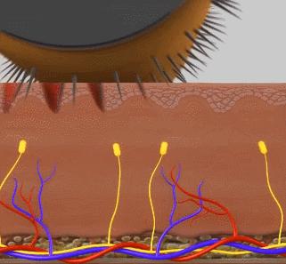 昕芙丽效果好吗,微针昕芙丽