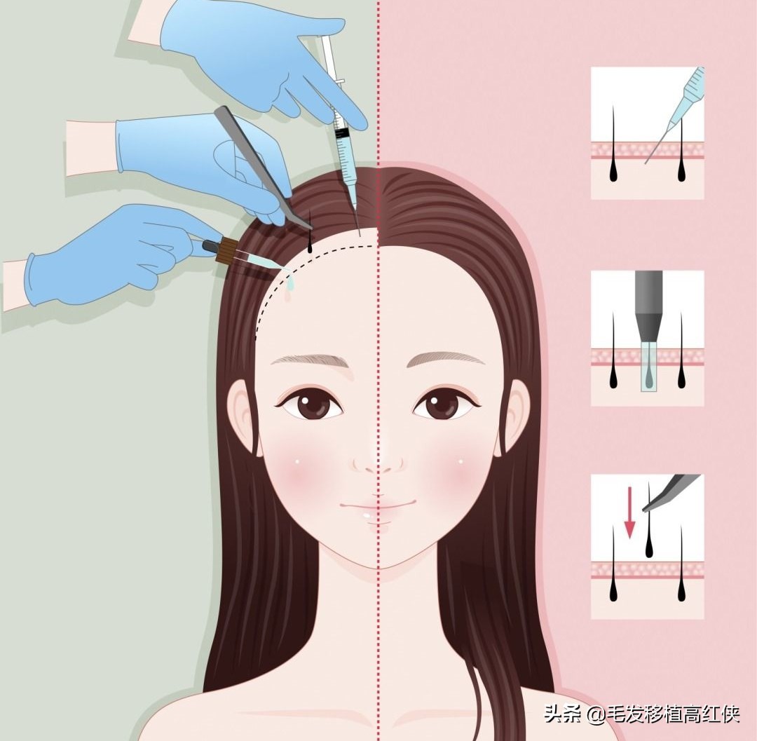植发到底疼不疼,植发疼不疼