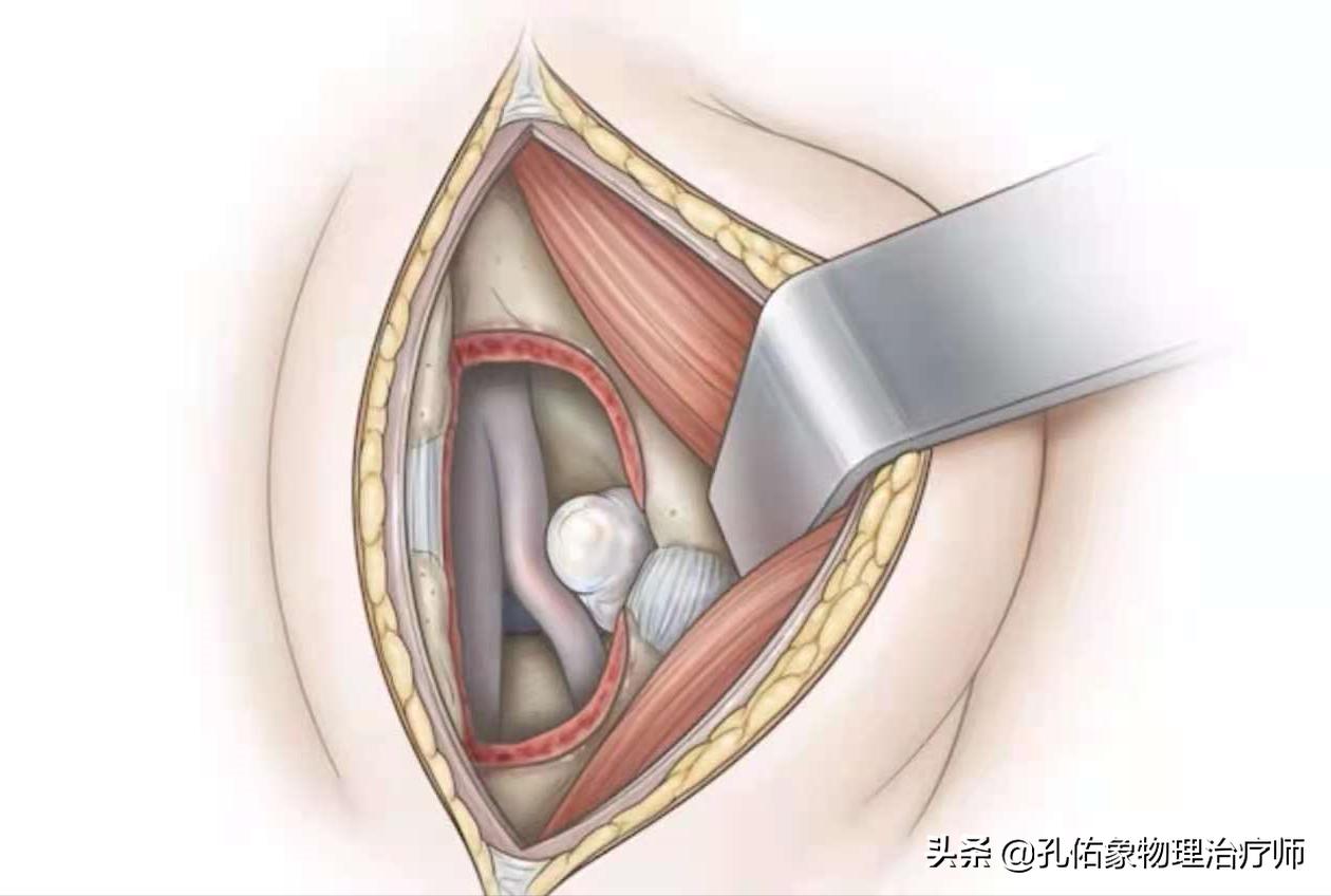 腰椎间盘突出压迫神经腿和屁股疼,腰椎间盘突出压迫神经屁股和腿麻