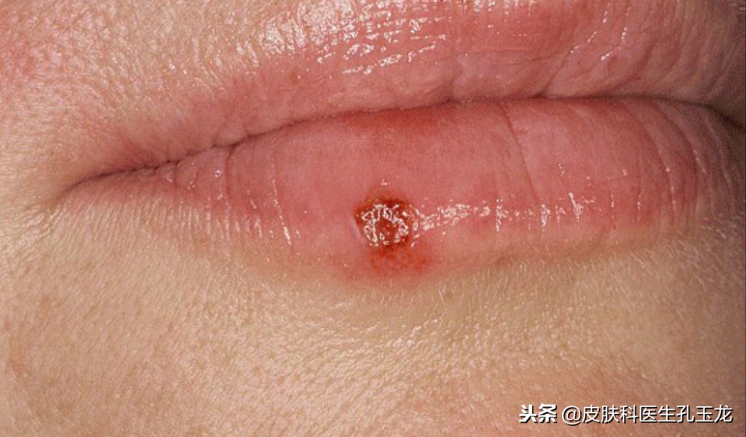 皮肤科单纯疱疹专家,上火嘴上起的疱疹什么原因