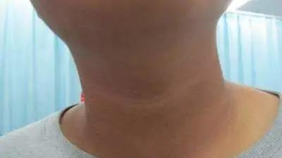 不是“脏”!孩子脖子一圈黑,妈妈用清洁球都擦洗不掉……