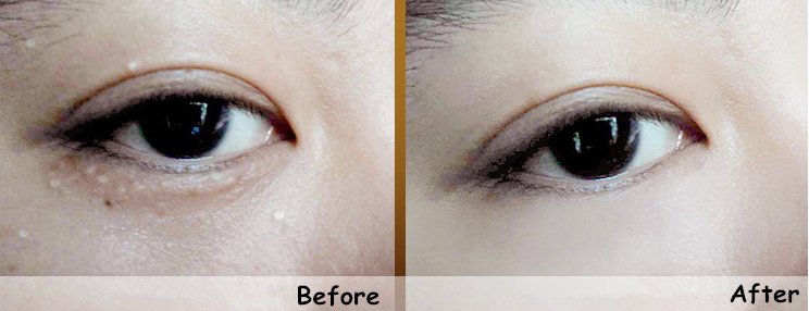 脂肪粒去粒神器 (日本自动消除脂肪粒)