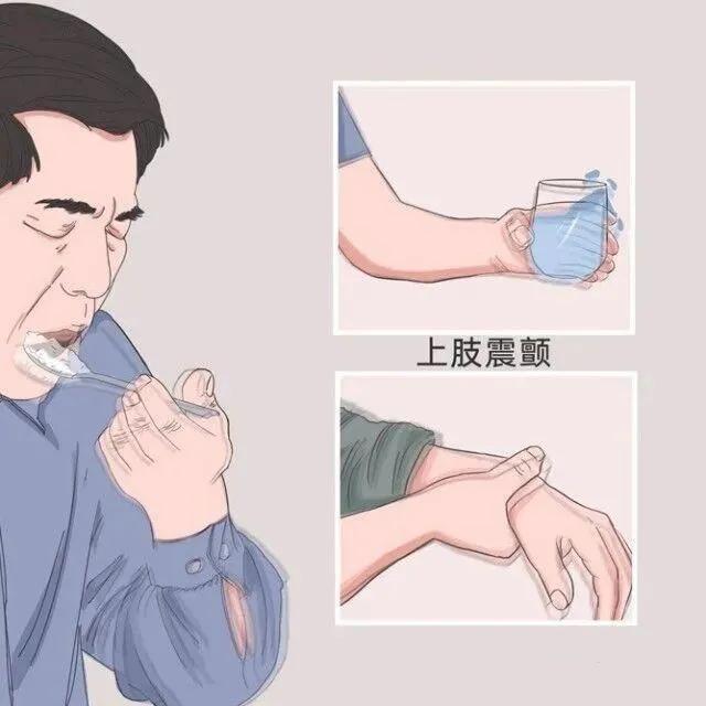 用筷子夹菜手抖是否是帕金森前兆,无缘无故手抖是得抑郁症