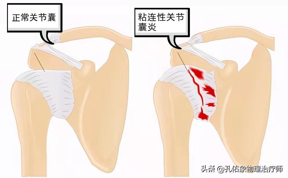 肩周炎肩膀疼痛用什么药,肩膀疼是肩周炎吗还是其他原因