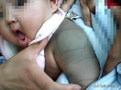 青胎记成因症状及危害科普,背中间靠左青胎记代表什么