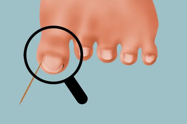 脚趾甲往肉里长又疼又痒教你一招,脚趾甲总是往肉里长怎么办