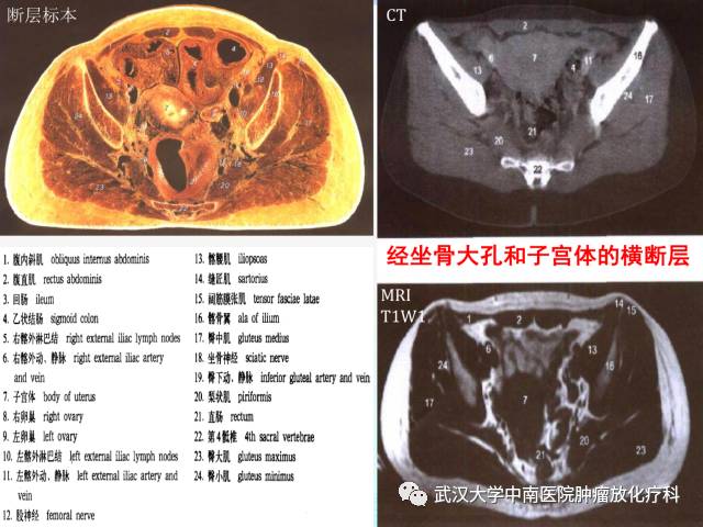 女性盆腔解剖与断层影像
